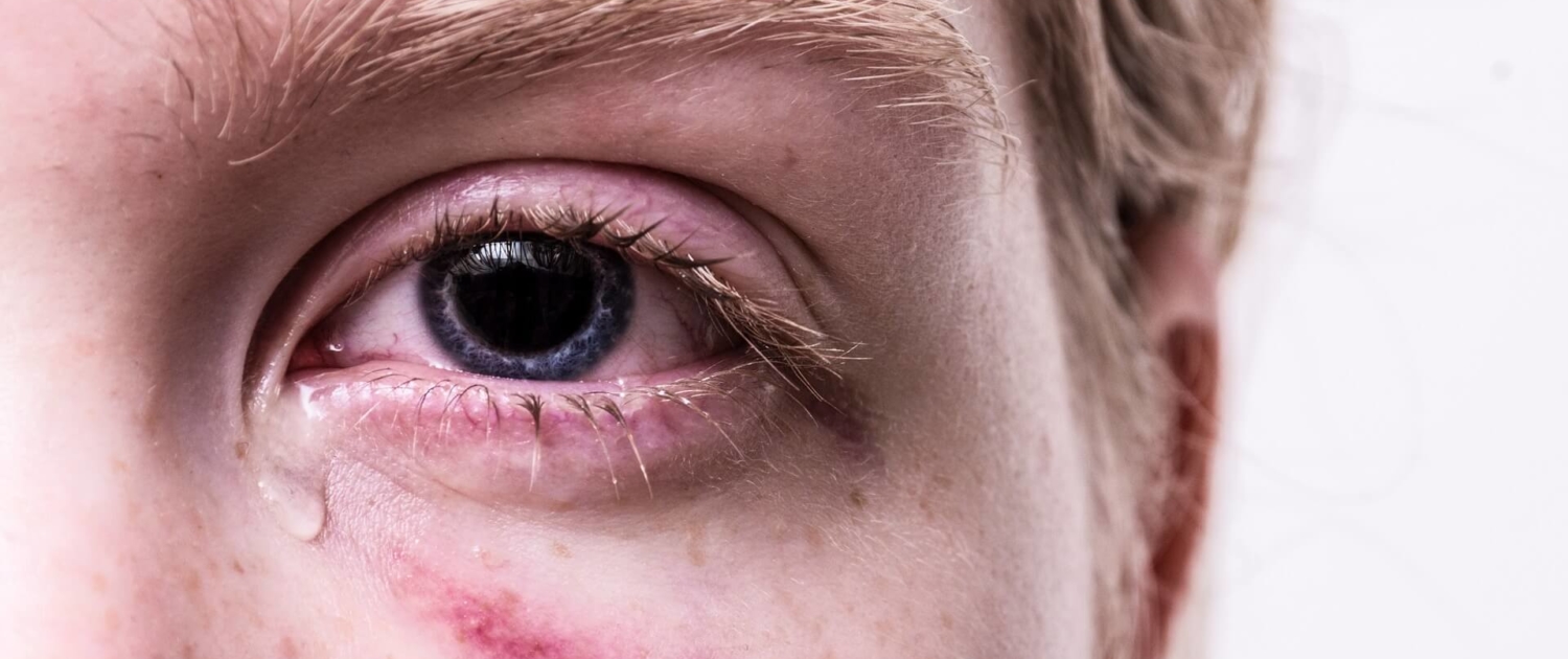 Auge-Augenkrankheiten-Augenschmerzen-Header-Bild